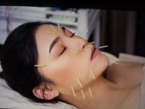 Akupunktur bei Migräne